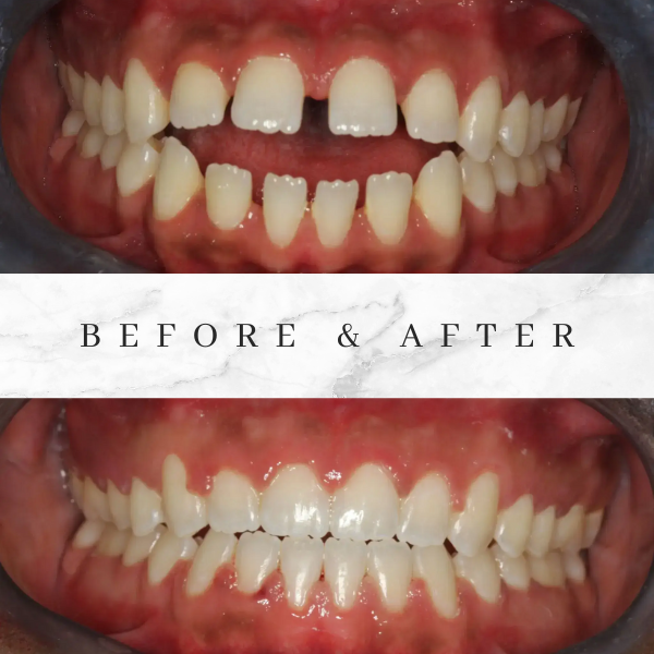 Braces Teeth Alignment before and after