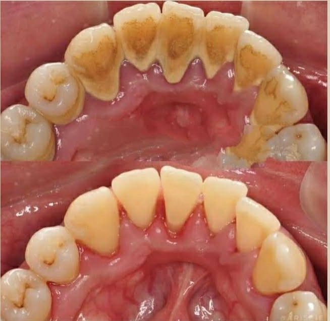 Teeth Scaling & Plaque Removal before and after